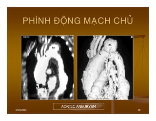 6/19/2013 58
PHÌNH ÑOÄNG MAÏCH CHUÛ
AORTIC ANEURYSM
 