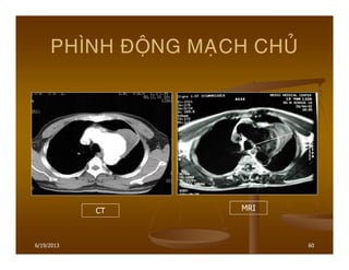 6/19/2013 60
PHÌNH ÑOÄNG MAÏCH CHUÛ
CT MRI
 