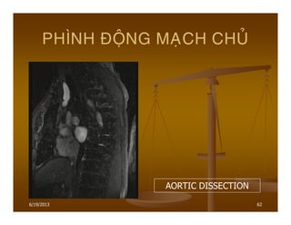 6/19/2013 62
PHÌNH ÑOÄNG MAÏCH CHUÛ
AORTIC DISSECTION
 