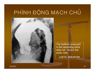 6/19/2013 64
PHÌNH ÑOÄNG MAÏCH CHUÛ
The fusiform aneurysm
in the ascending aorta
does not involve the
aortic root.
LUETIC ANEURYSM
 
