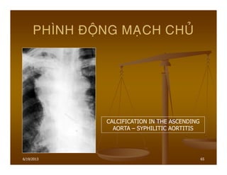6/19/2013 65
PHÌNH ÑOÄNG MAÏCH CHUÛ
CALCIFICATION IN THE ASCENDING
AORTA – SYPHILITIC AORTITIS
 