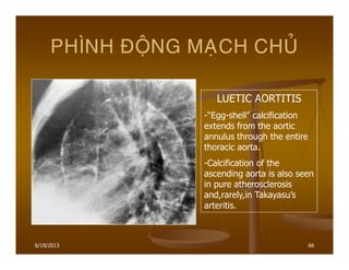 6/19/2013 66
PHÌNH ÑOÄNG MAÏCH CHUÛ
LUETIC AORTITIS
-“Egg-shell” calcification
extends from the aortic
annulus through the entire
thoracic aorta.
-Calcification of the
ascending aorta is also seen
in pure atherosclerosis
and,rarely,in Takayasu’s
arteritis.
 