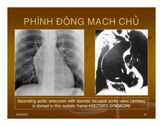 6/19/2013 67
PHÌNH ÑOÄNG MAÏCH CHUÛ
Ascending aortic aneurysm with stenotic bicuspid aortic valve (arrows)
is domed in this systolic frame REITER’S SYNDROME
 
