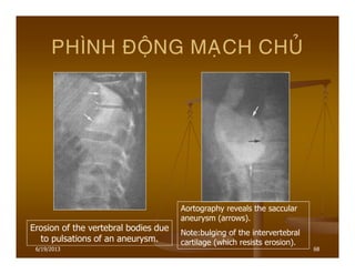 6/19/2013 68
PHÌNH ÑOÄNG MAÏCH CHUÛ
Erosion of the vertebral bodies due
to pulsations of an aneurysm.
Aortography reveals the saccular
aneurysm (arrows).
Note:bulging of the intervertebral
cartilage (which resists erosion).
 