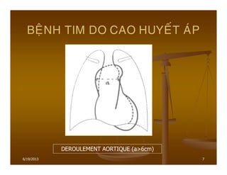 6/19/2013 7
BEÄNH TIM DO CAO HUYEÁT AÙP
DEROULEMENT AORTIQUE (a>6cm)
 