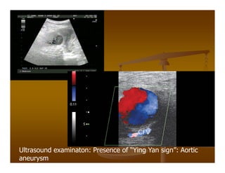 Ultrasound examinaton: Presence of “Ying Yan sign”: Aortic
aneurysm
 