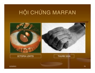 6/19/2013 74
HOÄI CHÖÙNG MARFAN
ECTOPIA LENTIS THUMB SIGN
 
