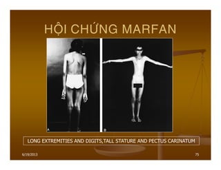 6/19/2013 75
HOÄI CHÖÙNG MARFAN
LONG EXTREMITIES AND DIGITS,TALL STATURE AND PECTUS CARINATUM
 