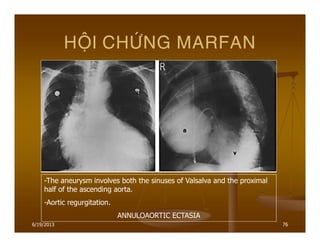 6/19/2013 76
HOÄI CHÖÙNG MARFAN
-The aneurysm involves both the sinuses of Valsalva and the proximal
half of the ascending aorta.
-Aortic regurgitation.
ANNULOAORTIC ECTASIA
 