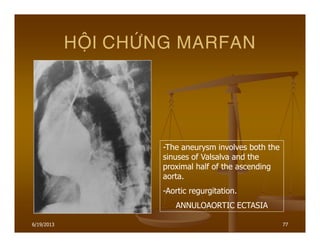 6/19/2013 77
HOÄI CHÖÙNG MARFAN
-The aneurysm involves both the
sinuses of Valsalva and the
proximal half of the ascending
aorta.
-Aortic regurgitation.
ANNULOAORTIC ECTASIA
 
