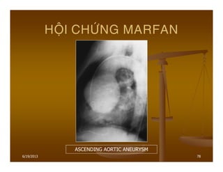 6/19/2013 78
HOÄI CHÖÙNG MARFAN
ASCENDING AORTIC ANEURYSM
 