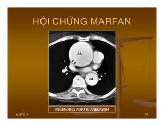 6/19/2013 79
HOÄI CHÖÙNG MARFAN
ASCENDING AORTIC ANEURYSM
 