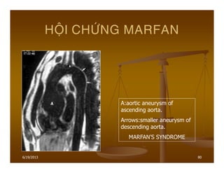 6/19/2013 80
HOÄI CHÖÙNG MARFAN
A:aortic aneurysm of
ascending aorta.
Arrows:smaller aneurysm of
descending aorta.
MARFAN’S SYNDROME
 