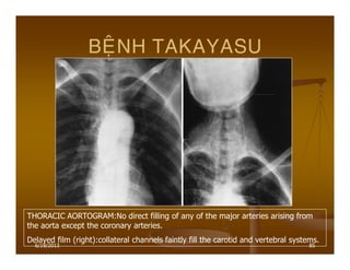 6/19/2013 85
BEÄNH TAKAYASU
THORACIC AORTOGRAM:No direct filling of any of the major arteries arising from
the aorta except the coronary arteries.
Delayed film (right):collateral channels faintly fill the carotid and vertebral systems.
 