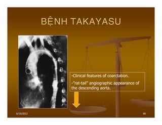 6/19/2013 86
BEÄNH TAKAYASU
-Clinical features of coarctation.
-”rat-tail” angiographic appearance of
the descending aorta.
 