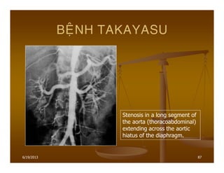 6/19/2013 87
BEÄNH TAKAYASU
Stenosis in a long segment of
the aorta (thoracoabdominal)
extending across the aortic
hiatus of the diaphragm.
 