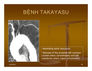 6/19/2013 89
BEÄNH TAKAYASU
-Ascending aortic aneurysm.
-Stenosis of the proximal left common
carotid artery (arrowheads) and left
subclavian artery (open arrowheads).
 