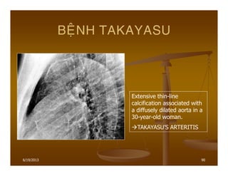 6/19/2013 90
BEÄNH TAKAYASU
Extensive thin-line
calcification associated with
a diffusely dilated aorta in a
30-year-old woman.
TAKAYASU’S ARTERITIS
 