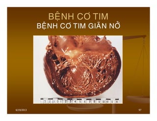 6/19/2013 97
BEÄNH CÔ TIM
BEÄNH CÔ TIM GIAÕN NÔÛ
 