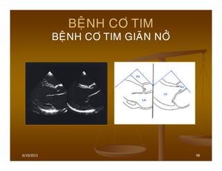 6/19/2013 98
BEÄNH CÔ TIM
BEÄNH CÔ TIM GIAÕN NÔÛ
 