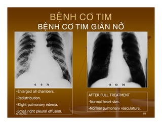 6/19/2013 99
BEÄNH CÔ TIM
BEÄNH CÔ TIM GIAÕN NÔÛ
-Enlarged all chambers.
-Redistribution.
-Slight pulmonary edema.
-Small right pleural effusion.
AFTER FULL TREATMENT
-Normal heart size.
-Normal pulmonary vasculature.
 
