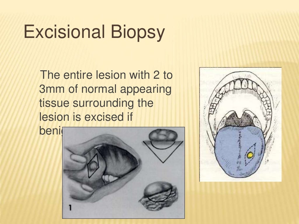 Biopsy ( oral pathology)