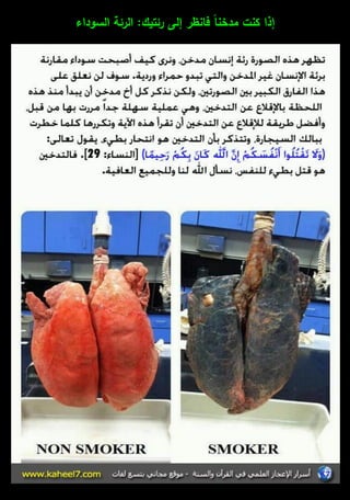 إذا كنت مدخناً فانظر إلى رئتيؾ: الرئة السوداء 
 