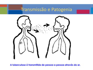 A tuberculose é transmitida de pessoa a pessoa através do ar.
TB:ETIOPATOGENIAECLÍNICA
Transmissão e Patogenia
 