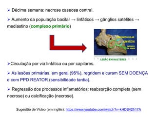  Décima semana: necrose caseosa central.
 Aumento da população bacilar → linfáticos → gânglios satélites →
mediastino (complexo primário)
Circulação por via linfática ou por capilares.
 As lesões primárias, em geral (95%), regridem e curam SEM DOENÇA
e com PPD REATOR (sensibilidade tardia).
 Regressão dos processos inflamatórios: reabsorção completa (sem
necrose) ou calcificação (necrose).
Sugestão de Vídeo (em inglês): https://www.youtube.com/watch?v=kHDS42fr17A
 