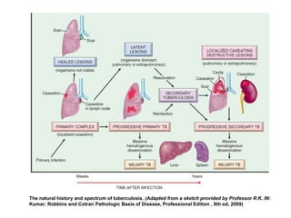 The natural history and spectrum of tuberculosis. (Adapted from a sketch provided by Professor R.K. IN:
Kumar: Robbins and Cotran Pathologic Basis of Disease, Professional Edition , 8th ed, 2009)
 