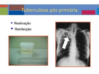  Reativação
 Reinfecção
Tuberculose pós primária
 