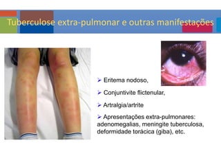  Eritema nodoso,
 Conjuntivite flictenular,
 Artralgia/artrite
 Apresentações extra-pulmonares:
adenomegalias, meningite tuberculosa,
deformidade torácica (giba), etc.
Tuberculose extra-pulmonar e outras manifestações
 