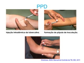 Injeção intradérmica da tuberculina. Formação de pápula de inoculação.
Mensuração Correta
PPD
Diretrizes, 2009; Manual de Controle de TB, MS, 2011
 