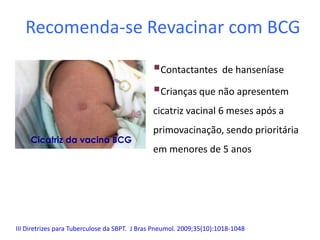 Recomenda-se Revacinar com BCG
Contactantes de hanseníase
Crianças que não apresentem
cicatriz vacinal 6 meses após a
primovacinação, sendo prioritária
em menores de 5 anos
Cicatriz da vacina BCG
III Diretrizes para Tuberculose da SBPT. J Bras Pneumol. 2009;35(10):1018-1048
 