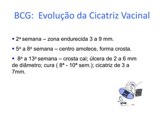  2a semana – zona endurecida 3 a 9 mm.
 5a a 8a semana – centro amolece, forma crosta.
 8a a 13a semana – crosta cai; úlcera de 2 a 6 mm
de diâmetro; cura ( 8ª - 10ª sem.); cicatriz de 3 a
7mm.
BCG: Evolução da Cicatriz Vacinal
 