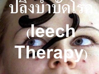 ปลิงบำบัดโรค
(leech
Therapy)
 