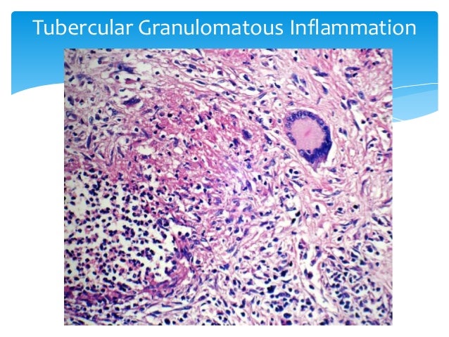 4. chronic inflammation granulomatous inflammation dr. sinhasan md…