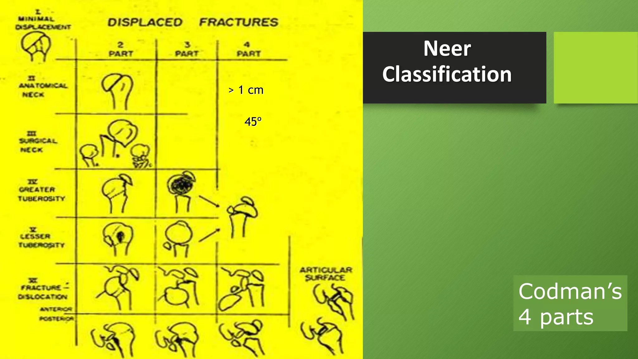 Neer
Classification
Codman’s
4 parts
> 1 cm
45º
 