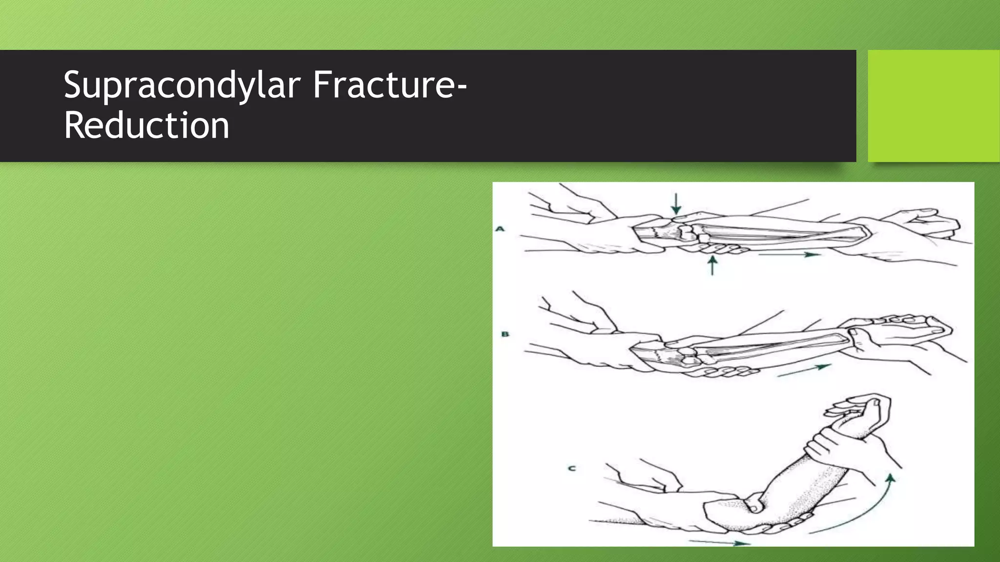 Supracondylar Fracture-
Reduction
 