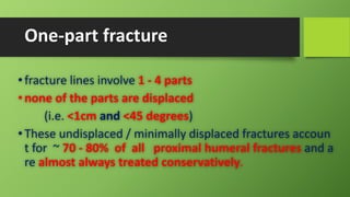 One-part fracture
•fracture lines involve 1 - 4 parts
•none of the parts are displaced
(i.e. <1cm and <45 degrees)
•These undisplaced / minimally displaced fractures accoun
t for ~ 70 - 80% of all proximal humeral fractures and a
re almost always treated conservatively.
 