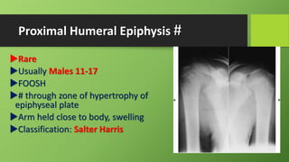 Proximal Humeral Epiphysis #
Rare
Usually Males 11-17
FOOSH
# through zone of hypertrophy of
epiphyseal plate
Arm held close to body, swelling
Classification: Salter Harris
 