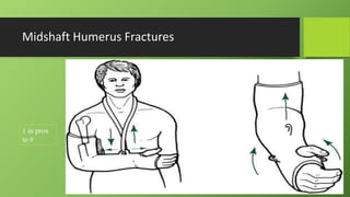 Midshaft Humerus Fractures
1 in prox
to #
 