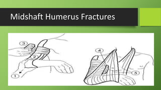 Midshaft Humerus Fractures
 