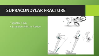 SUPRACONDYLAR FRACTURE
• Usually < 8yo
• Extension (95%) vs flexion
 