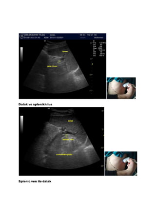 Dalak ve splenikhilus
Splenic ven ile dalak
 