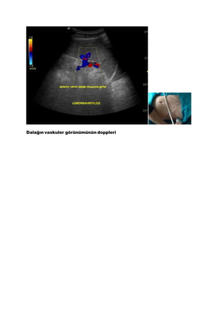 Dalağın vaskuler görünümünün doppleri
 