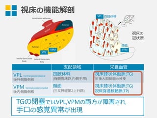 視床の
冠状断
視床の機能解剖 VPL
VPM
⽀支配領領域 栄養⾎血管
VPL Ventral posterolateral
後外側腹側核
四肢体幹
(脊髄視床路路,内側⽑毛帯)
視床膝状体動脈(TG)
※後⼤大脳動脈の分枝
VPM Ventral posteromedial
後内側腹側核
顔⾯面
(三叉神経第2上⾏行行路路)
視床膝状体動脈(TG)
視床穿通枝動脈(TP)
VPL
VPM
TGの閉塞塞ではVPL,VPMの両⽅方が障害され,
⼿手⼝口の感覚異異常が出現
四肢体幹
顔⾯面
 
