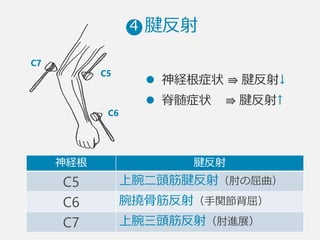  　  腱反射4
l  神経根症状  ⇛  腱反射↓
l  脊髄症状        ⇛  腱反射↑
神経根 腱反射
C5 上腕⼆二頭筋腱反射（肘の屈曲）
C6 腕撓⾻骨筋反射（⼿手関節背屈）
C7 上腕三頭筋反射（肘進展）
C5
C6
C7
 