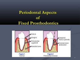 1 1
Periodontal AspePeriodontal Aspectscts
ofof
Fixed ProsthodonticsFixed Prosthodontics
 