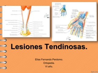 Lesiones Tendinosas.
Elías Fernando Perdomo.
Ortopedia.
VI año.
 